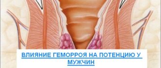 Влияние геморроя на потенцию у мужчин