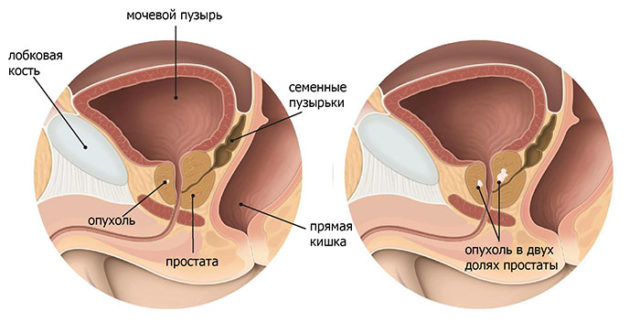 киста предстательной железы у мужчин лечение