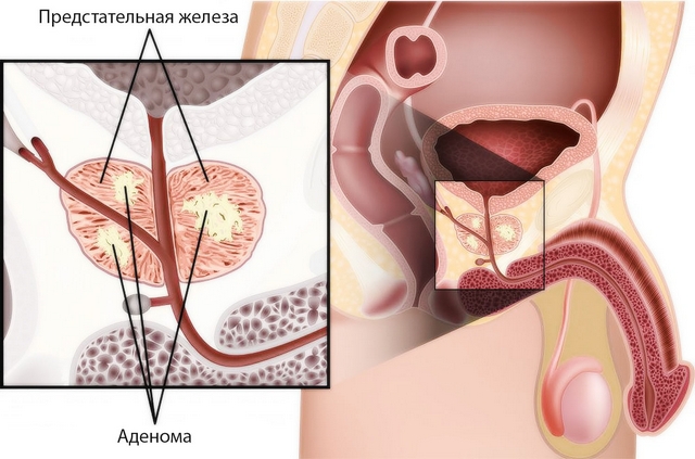 мелкоацинарная аденокарцинома предстательной железы 