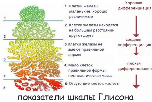 ацинарная аденокарцинома предстательной железы 6 баллов по глисону