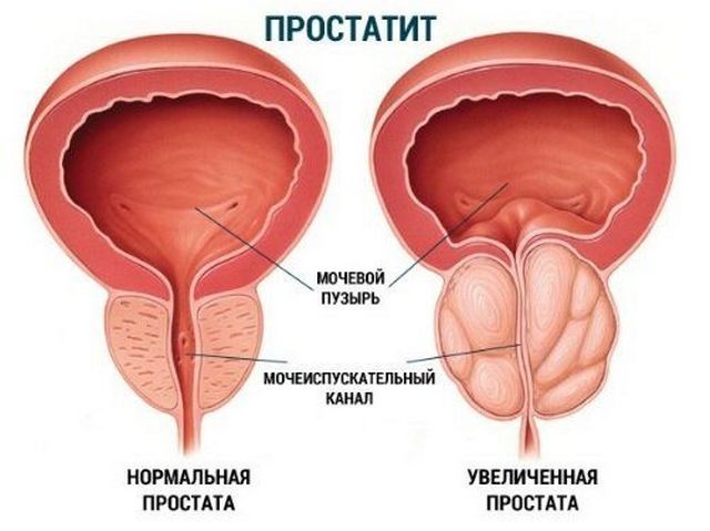 воспаление